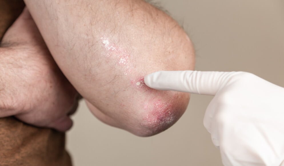 7 фактов о грибковых заболеваниях кожи
