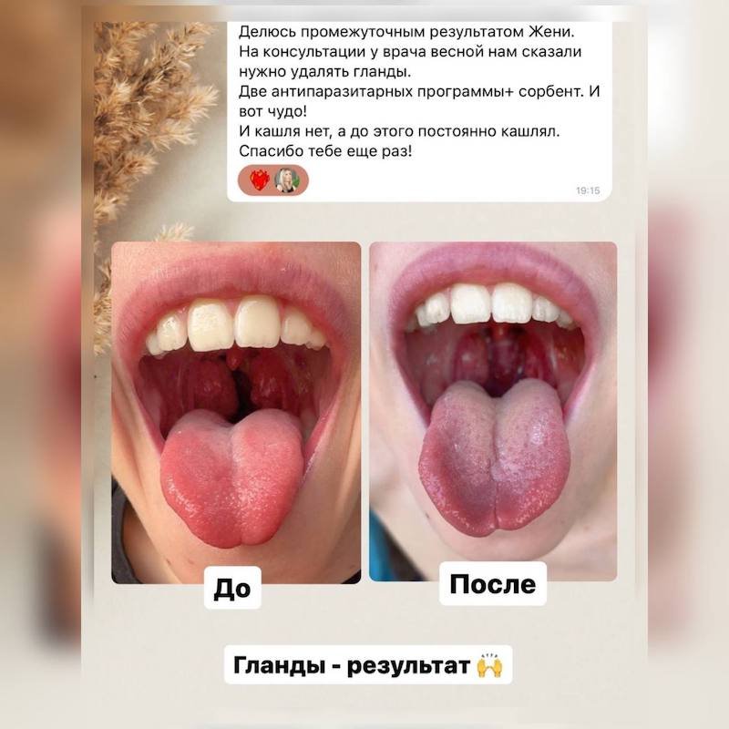 Парашилд (Parashield): антипаразитарная программа 2 Antiparazitarnaya glandy